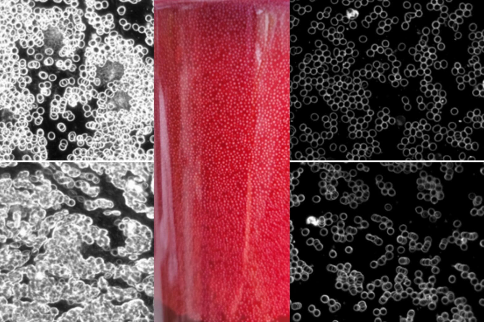 Theraklinik Long COVID Blutwäsche – Blut im Dunkelfeldmikroskop vor (links) und nach (rechts) Blutreinigung (HTA)