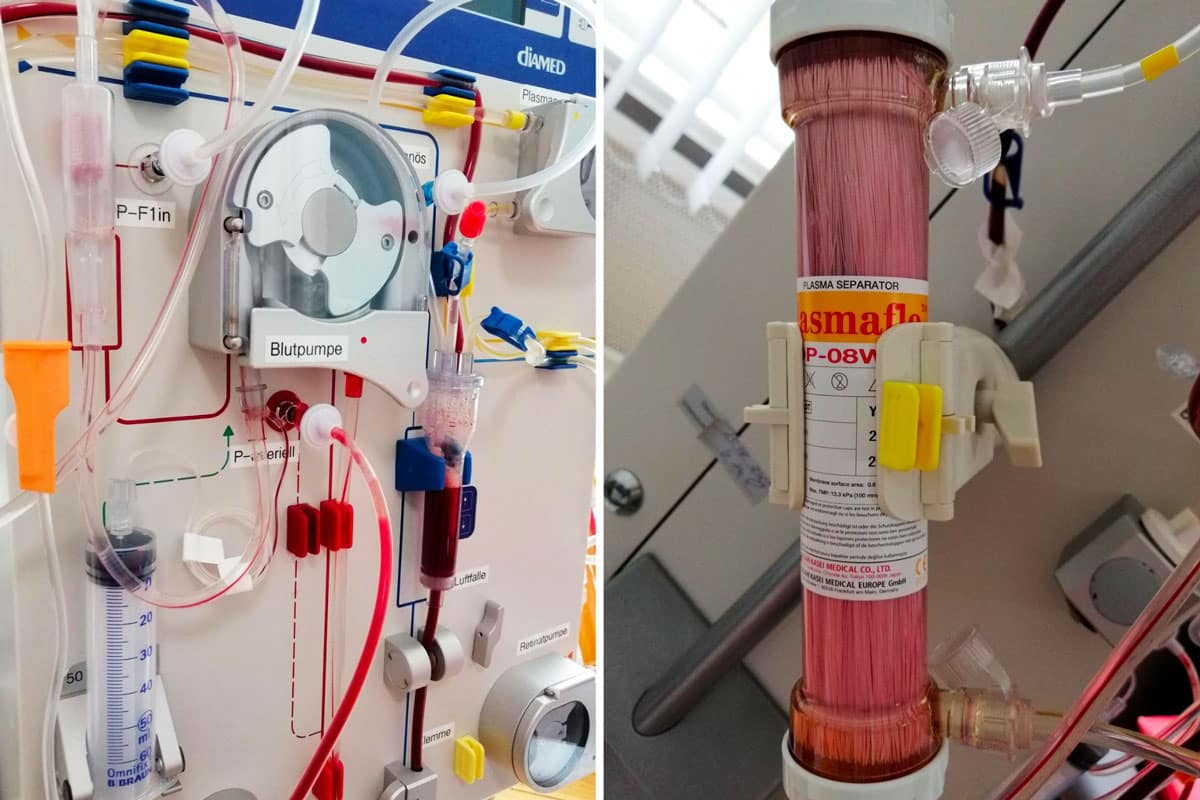 Geräteaufbau (links) und Filtersystem (rechts) bei der Blutwäsche